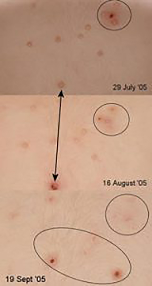 Upper and lower back. Note disappearance of molluscum spots.