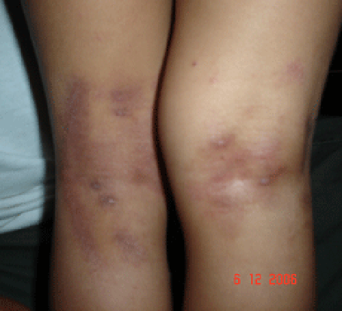 pop_fossa_burns_postWG After 9 days daily treatment with Wheatgrass extract, the burns have completely healed, mild skin discoloration persists and the child is pain free. Molluscum spots have almost disappeared.