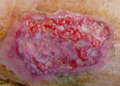 skingraft_leg_15dec06 Fig. 1. Skin graft before wheatgrass application. Note the poor blood supply and subsequent absence of vitality in the wound.
