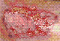 skingraft_leg_17dec06 Fig. 2. Two days later, inflammation is markedly reduced and blood circulation has improved significantly.