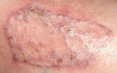 skingraft_leg_5Jan07 Fig. 3. The graft has completely healed in 3 weeks