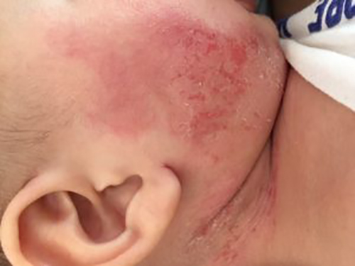 20160419-R-CHEEK-NECK-300x225 Topical steroid damage to facial skin.