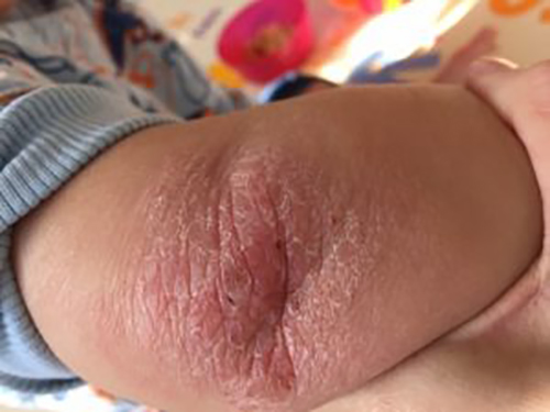 topical steroid withdrawal child