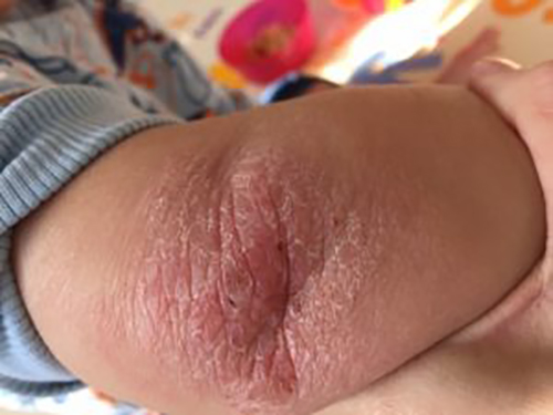 20160510-R-elbow-300x225 topical steroid withdrawal child