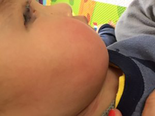 20160712-Rcheek-300x225 After 3 weeks’ daily application of wheatgrass extract, the child’s skin has significantly improved.