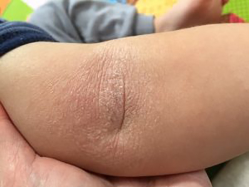20160712-elbow-almost-healed-300x225 Fig. 2. TS ceased. 3 weeks after daily wheatgrass extract. Damaged skin almost recovered.
