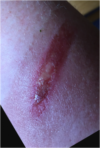 Burns. 2nd-degree burn healed by wheatgrass extract - A Medical Doctor