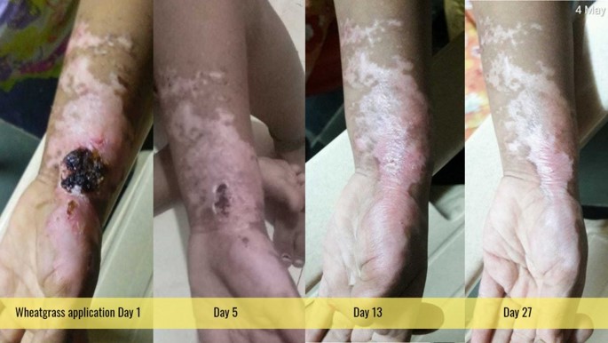 2nd degree burn wrist 2nd degree burn wrist