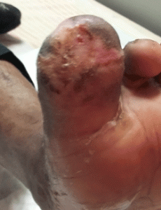 CVK-Patient-A.-1-week-WG-230x300 One week later, wound has almost healed. No infection present.