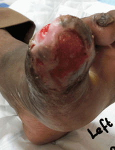 CVK-Patient-A.-Pre-WG-230x300 Surgical “cleansing” (debridement) of wound. Followed by daily application of wheatgrass extract.