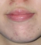 Chronic acne. 38 days WG treatment After 6 weeks wheatgrass.
