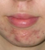 Chronic acne, pre-wheatgrass.tment. acne pre-wheatgrass