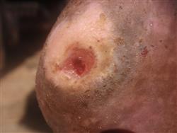 DFU_CASE2_6WKS 6 weeks. Wound continues to heal and is almost closed. Patient lost to follow-up