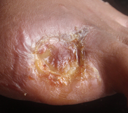 DFU_CASE3_1jun11- 5 weeks. Wound is significantly smaller & there is no pain or infection.