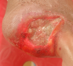 DFU_CASE3_25APR11 Diabetic toe amputation due to infection/gangrene. No response to placental extract. Wheatgrass commenced alternate days.