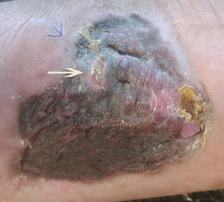 DFU_CASE5_29SEP11 After 3 weeks wheatgrass treatment, ulcer has healed. (arrow)