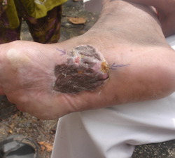 DFU_CASE5_foot Non-healing diabetic ulcer 6 months. Section of graft failed to heal (arrow).