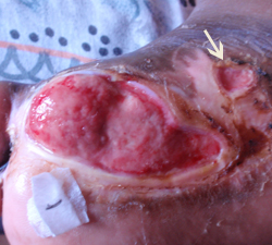 DFU_Case1_R_2mar11 Daily wheatgrass treatment commenced. Note satellite ulcer (arrow).