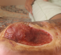 DFU_Case1_R_30apr11 2 months later. Ulcer is almost completely filled.