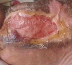 DFU_Case1_R_30jun11 At 4 months, wound sealed by cell regrowth. Skin graft refused.