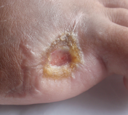 DFU_Case3_30Jun11 9 weeks. Ulcer contracting, dry & no infection. Unusual as amputation increases risk of bone infection. Antibiotics were not required.
