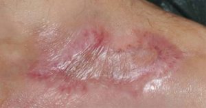 DFU_TH_10oct11-1-300x158 Fig. 3. Wound closed