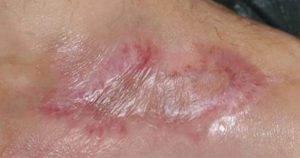 Fig. 3. Wound closed