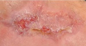 DFU_TH_11sep11-1-300x160 Fig. 2. Closing of the wound