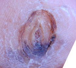 Diabetic-foot-ulcer-4-weeks-wheatgrass 4 weeks. Ulcer almost healed.