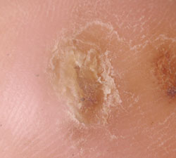 Diabetic-foot-ulcer-8weeks-wheatgrass 8 weeks. Ulcer healed.