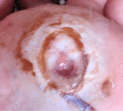 Diabetic-foot-ulcer-pre-wheatgrass-e1550465212299 Pre-wheatgrass. Note central blood clot (hematoma).