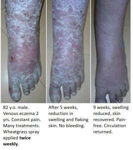 Severe venous eczema healed with wheatgrass