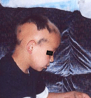 april07_alopecia_A april07_alopecia_A