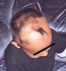 april07_alopecia_B april07_alopecia_B