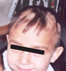 jan07_alopecia_B jan07_alopecia_B