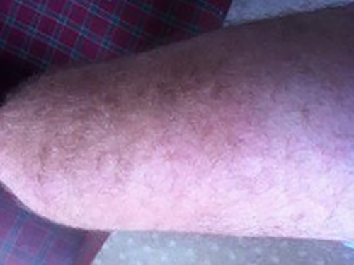 jellyfish-sting-case-2-After-Wheatgrass-by-Tracey-A-21-Feb-2016 20 minutes after wheatgrass extract applied. Welts are beginning to settle & pain easing.