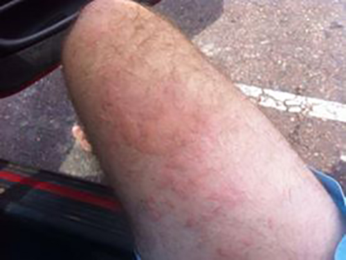 jellyfish-sting-case-2-by-Tracey-A-21-Feb-2016 Before wheatgrass extract. Large welts are clearly visible.