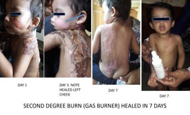 Second degree burns recover rapidly after wheatgrass extract applied to affected areas Second degree burns recover rapidly after wheatgrass extract applied to affected areas