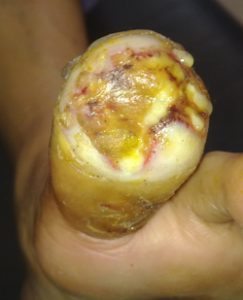 55 y.o. insulin-dependent diabetic. Ulcer 1 year. Day after surgical debridement and wheatgrass application. Treatment conducted in diabetic hospital, India.