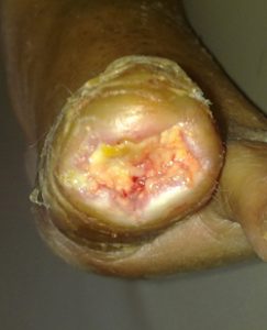zarine_2weeksWG-243x300 2 weeks later, wound is clean with rapid regrowth of normal skin around the wound.
