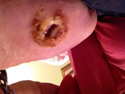20170801-pre-WG-treatment-twice-weekly-e1570413889621 Diabetic “Charcot” ulcer pre-wheatgrass.