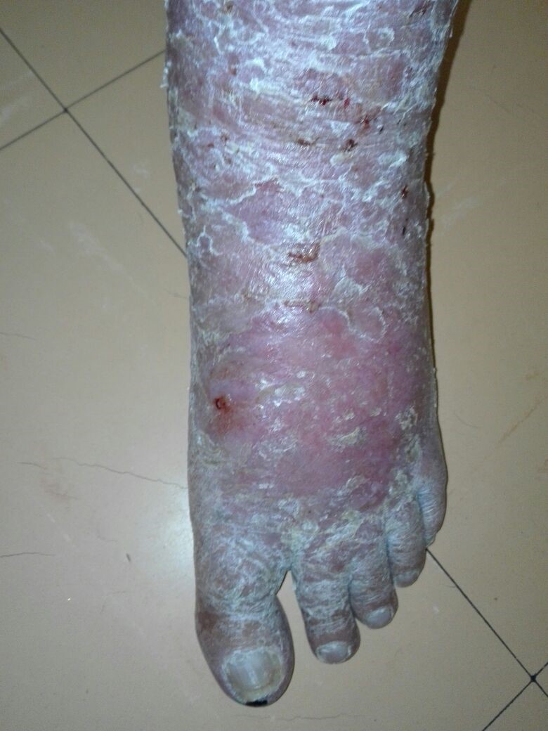65 y.o. male. Venous eczema 2 years. In constant pain. Unresponsive to numerous treatments. Poor blood circulation. Wheatgrass extract applied twice weekly.