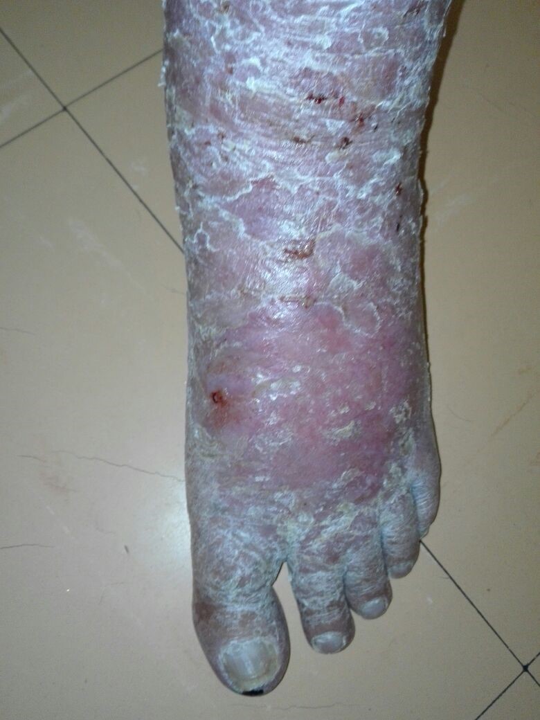 20171024 65 y.o. male. Venous eczema 2 years & in constant pain. Poor blood circulation is obvious. Unresponsive to numerous treatments. Wheatgrass extract application twice weekly achieves remarkable recovery.