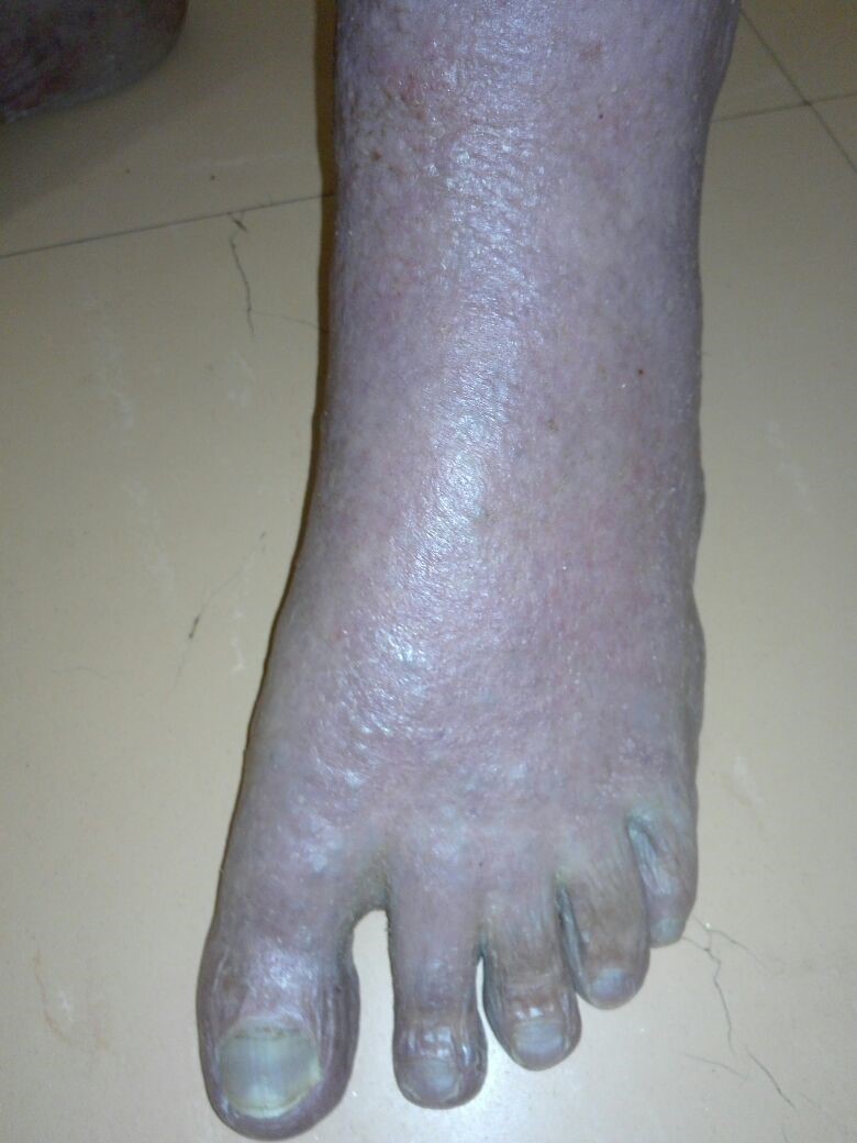 20171216 L FOOT 9 weeks wheatgrass. Marked reduction of swelling & skin almost normal. No skin flaking, and blood circulation has fully recovered.