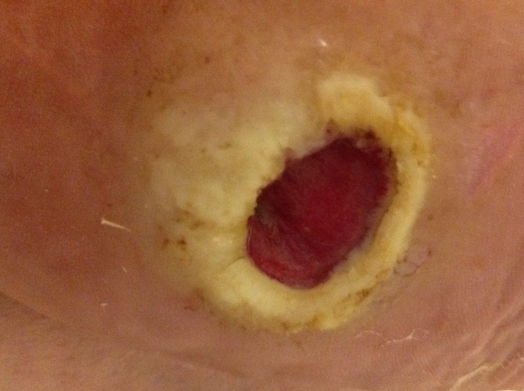 20180128-BETH-BUTTRAM-1024x765 Diabetic "Charcot" ulcer debrided with wheatgrass