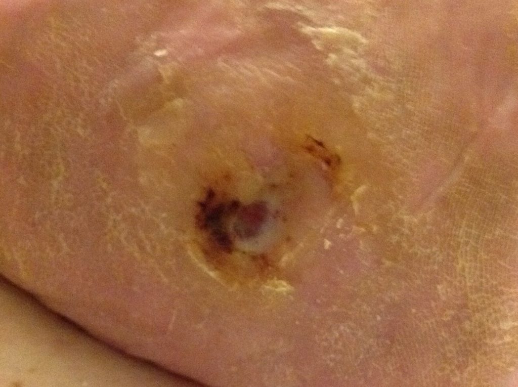 6 weeks later, aided by renewed blood supply, The ulcer has almost healed.