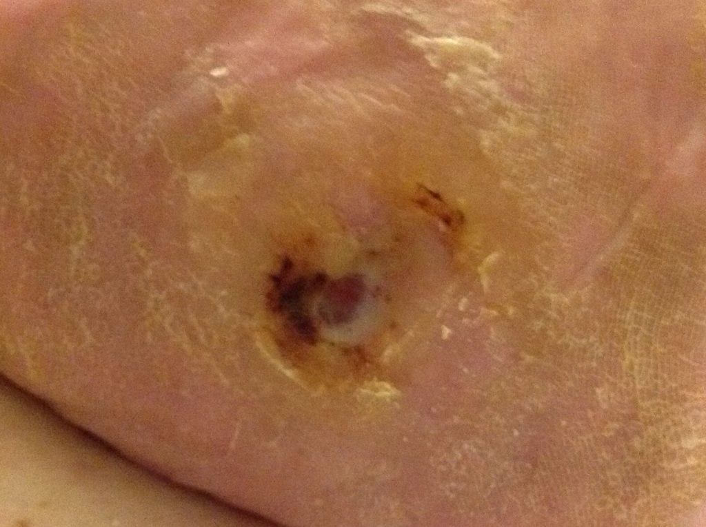 20180311-1024x765 6 weeks later, aided by renewed blood supply, The ulcer has almost healed.