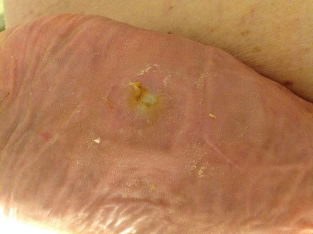 20180511-1024x765 2 months later, the wound is completely healed.