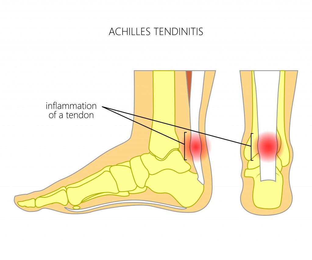 area of pain due to Achilles tendonitis