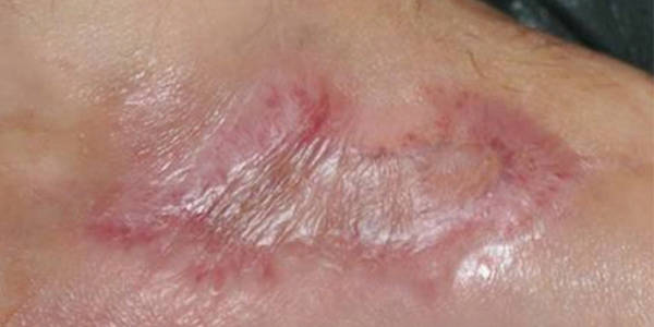 Fig. 3. Diabetic ulcer completely covered by skin after treatment with wheatgrass extract.
